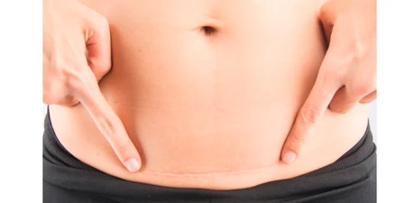 Tips chăm sóc vết mổ sau sinh mổ để đẩy nhanh quá trình lành