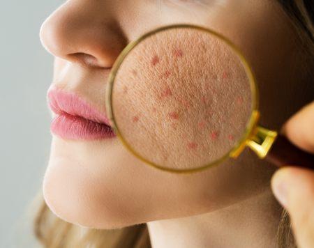 Làm sao để cải thiện mụn trứng cá tại nhà