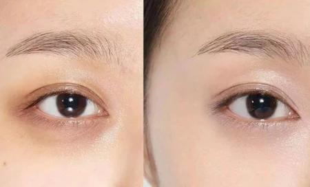 Cách xóa thâm quầng mắt bằng toner hiệu quả