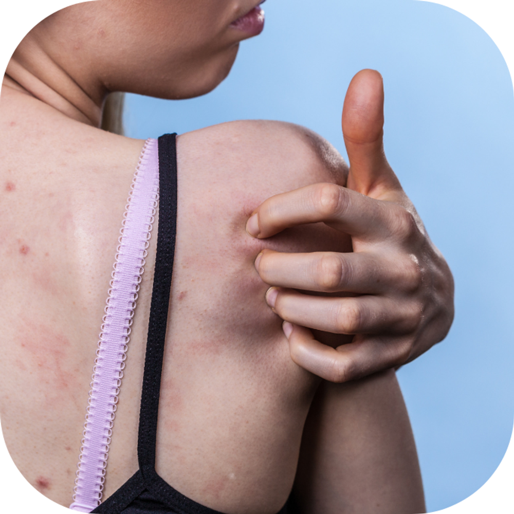 Mụn lưng Kingfoodmart