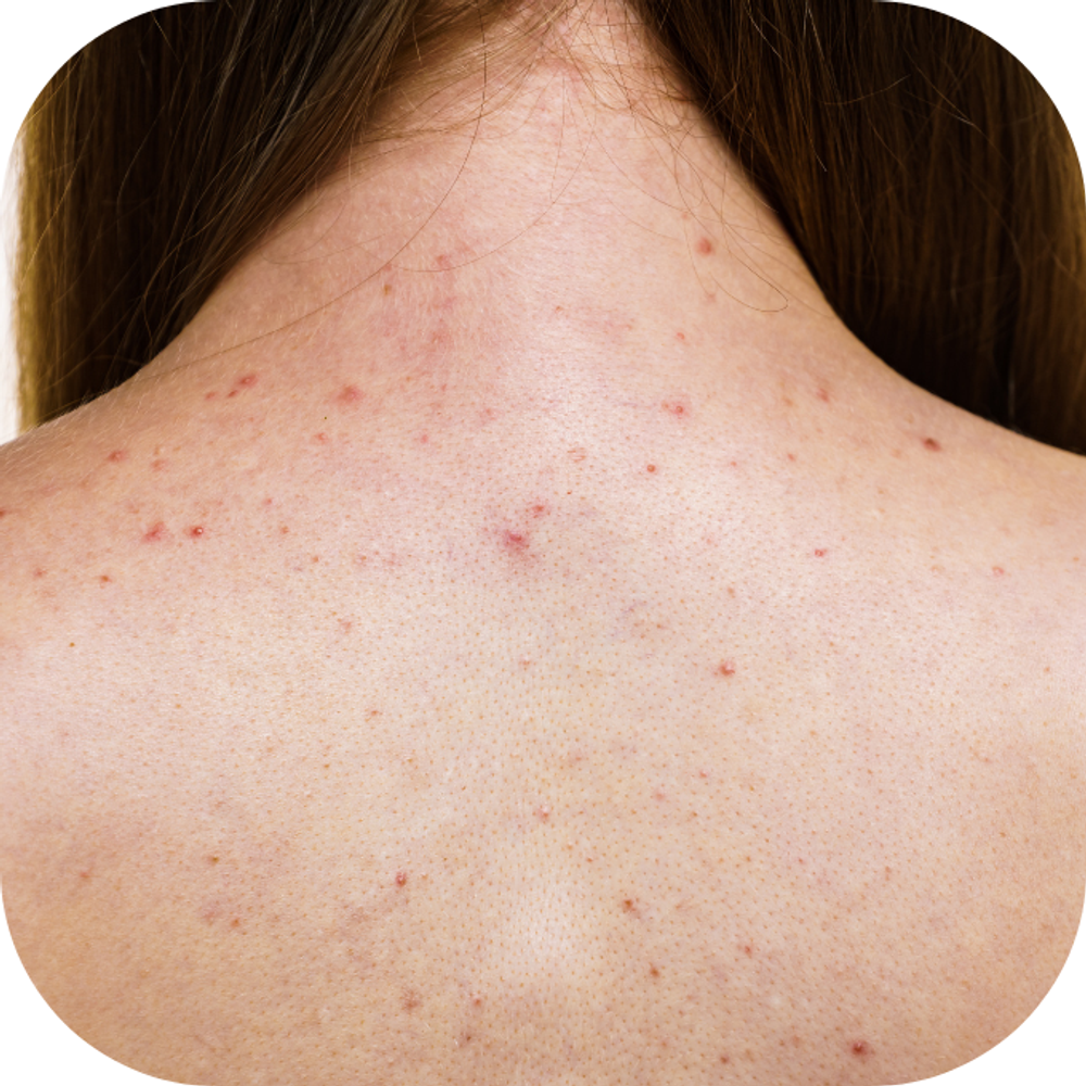 Mụn lưng Kingfoodmart