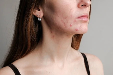 Tìm hiểu nguyên nhân và phương pháp điều trị mụn trứng cá