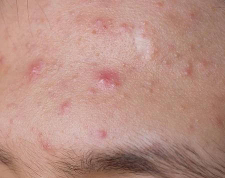 Nguyên nhân và cách điều trị của mụn trứng cá
