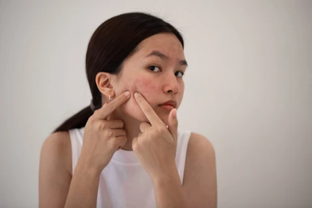 Nặn mụn có tác động hại cho da không?