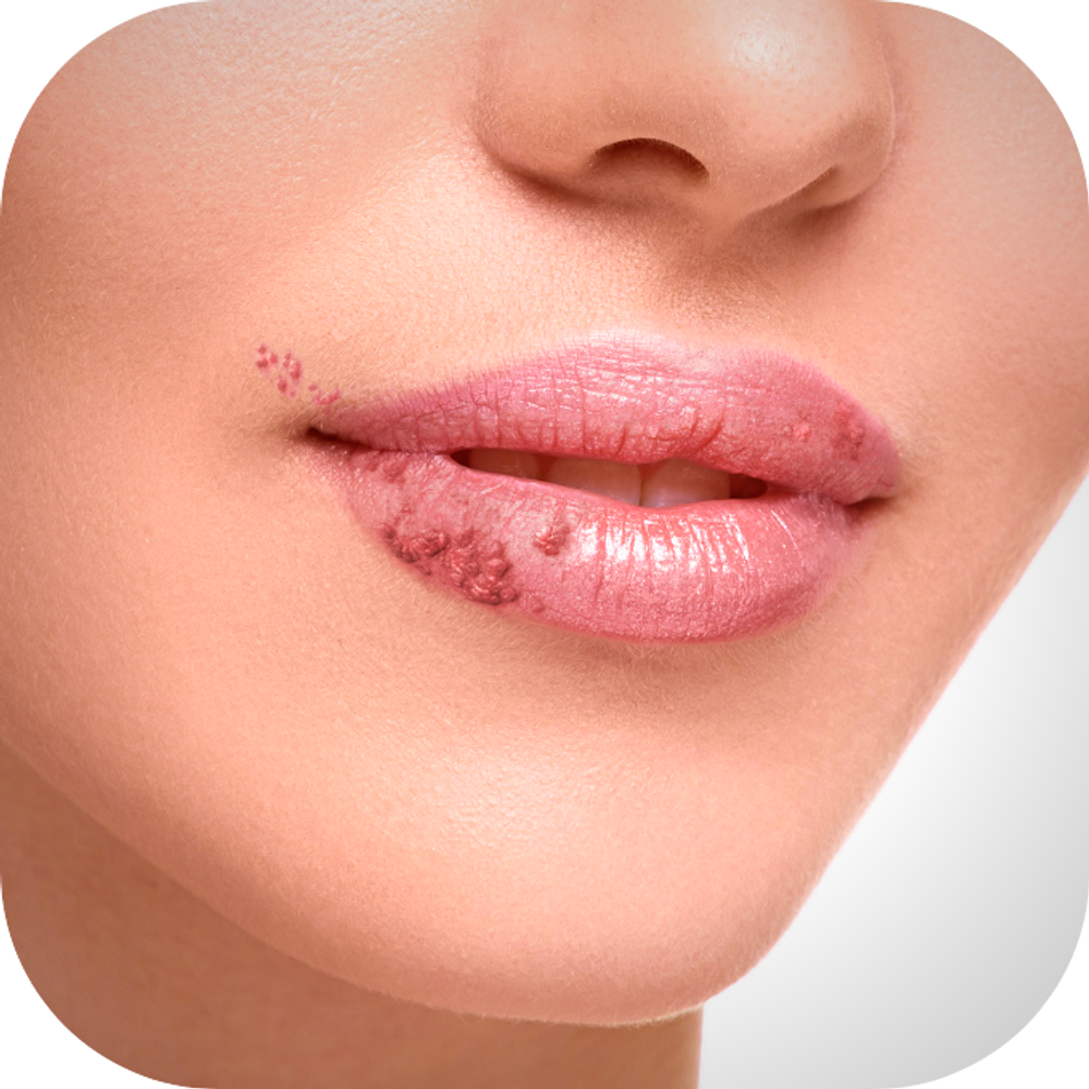 Da bị nhiễm trùng gây sưng môi Kingfoodmart