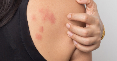 Làm gì để giảm cảm giác ngứa khi dị ứng?