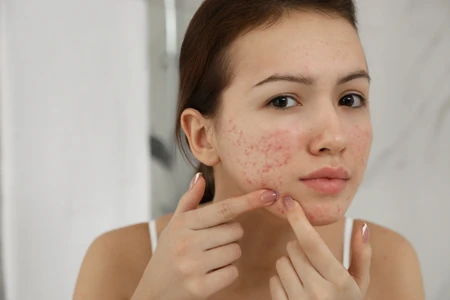 Chăm sóc da hiệu quả với mụn đầu đen và mụn đầu trắng