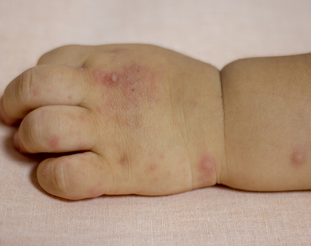 Những triệu chứng của bệnh tay chân miệng ở trẻ em