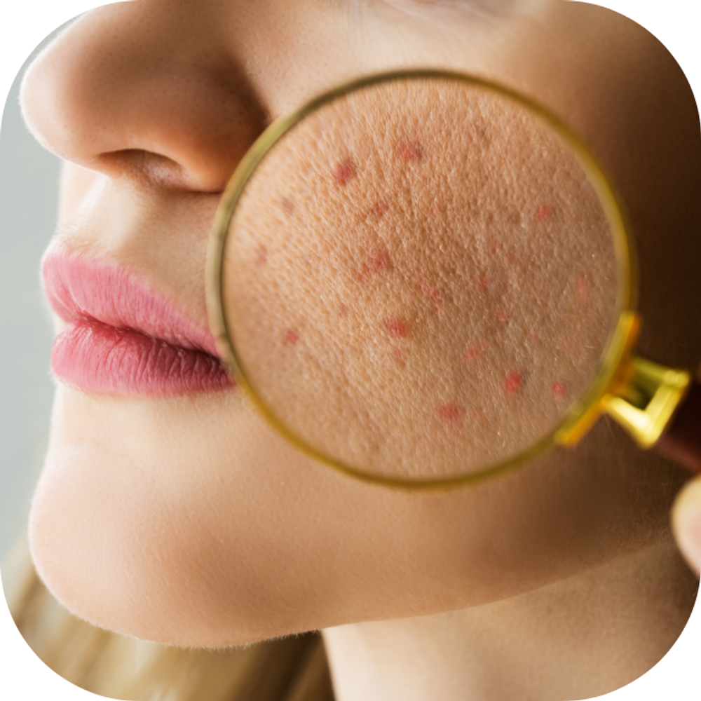 Da mụn Kingfoodmart