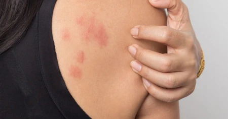 Làm gì để giảm cảm giác ngứa khi dị ứng?