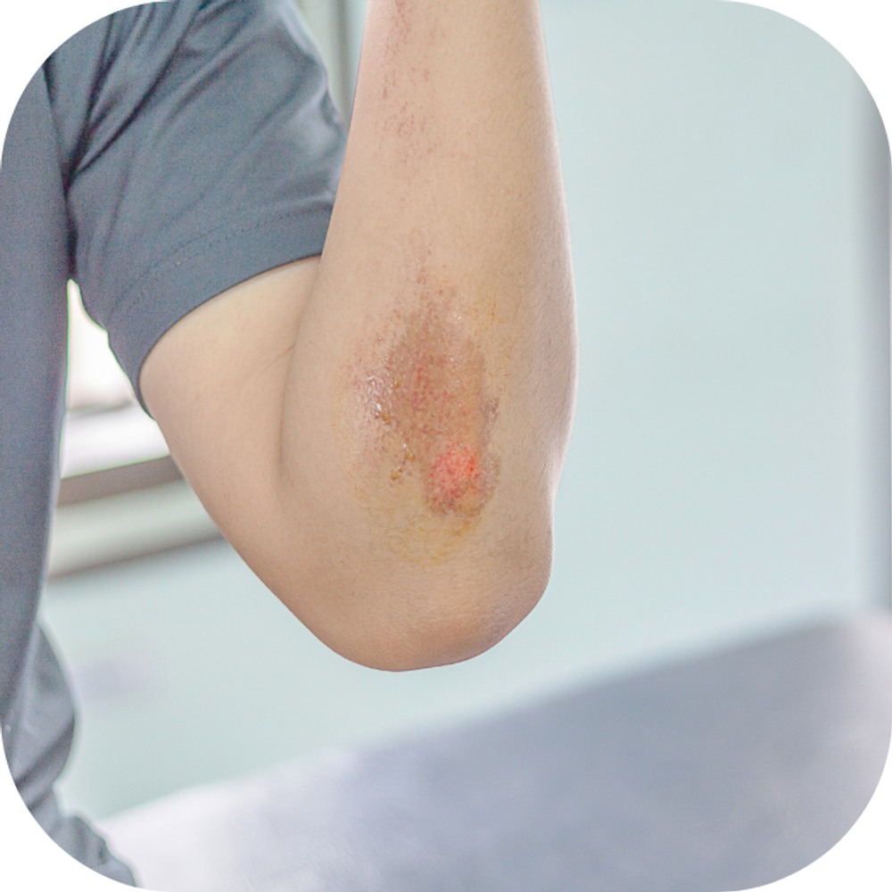 thịt gà ảnh hưởng tới vết thương hở Kingfoodmart