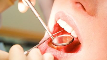 Những thực phẩm bạn nên ăn sau khi lấy cao răng