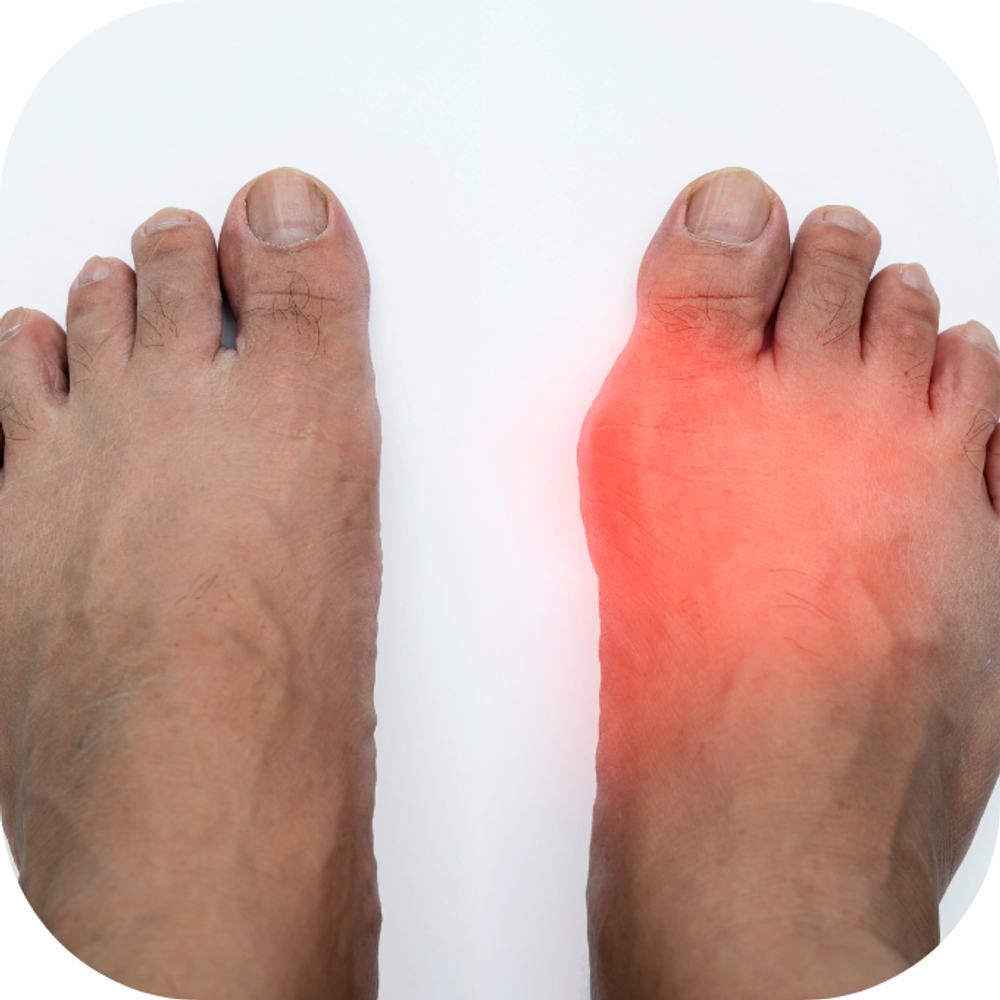 phòng tránh bệnh gút