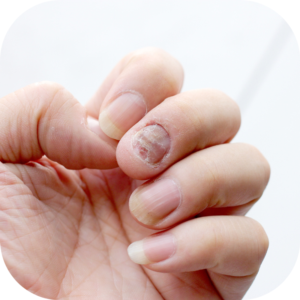 Bệnh vảy nến móng tay Kingfoodmart