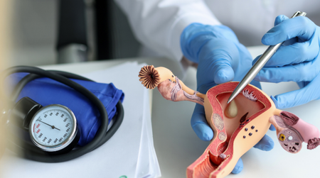 Tìm hiểu về u nang buồng trứng ở phụ nữ