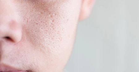 Cách trị mụn đầu đen và lỗ chân lông to ở mũi hiệu quả