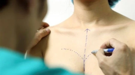Cách chăm sóc và chế độ ăn uống sau phẫu thuật nâng ngực