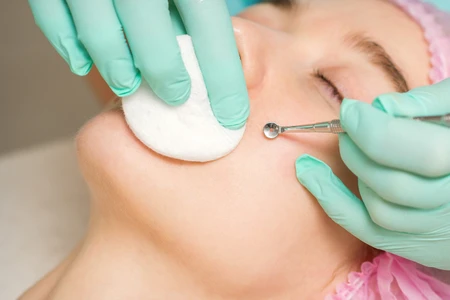 Hướng dẫn loại bỏ mụn đầu đen và cải thiện làn da