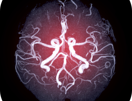 Tìm hiểu về tình trạng bệnh lý phình động mạch