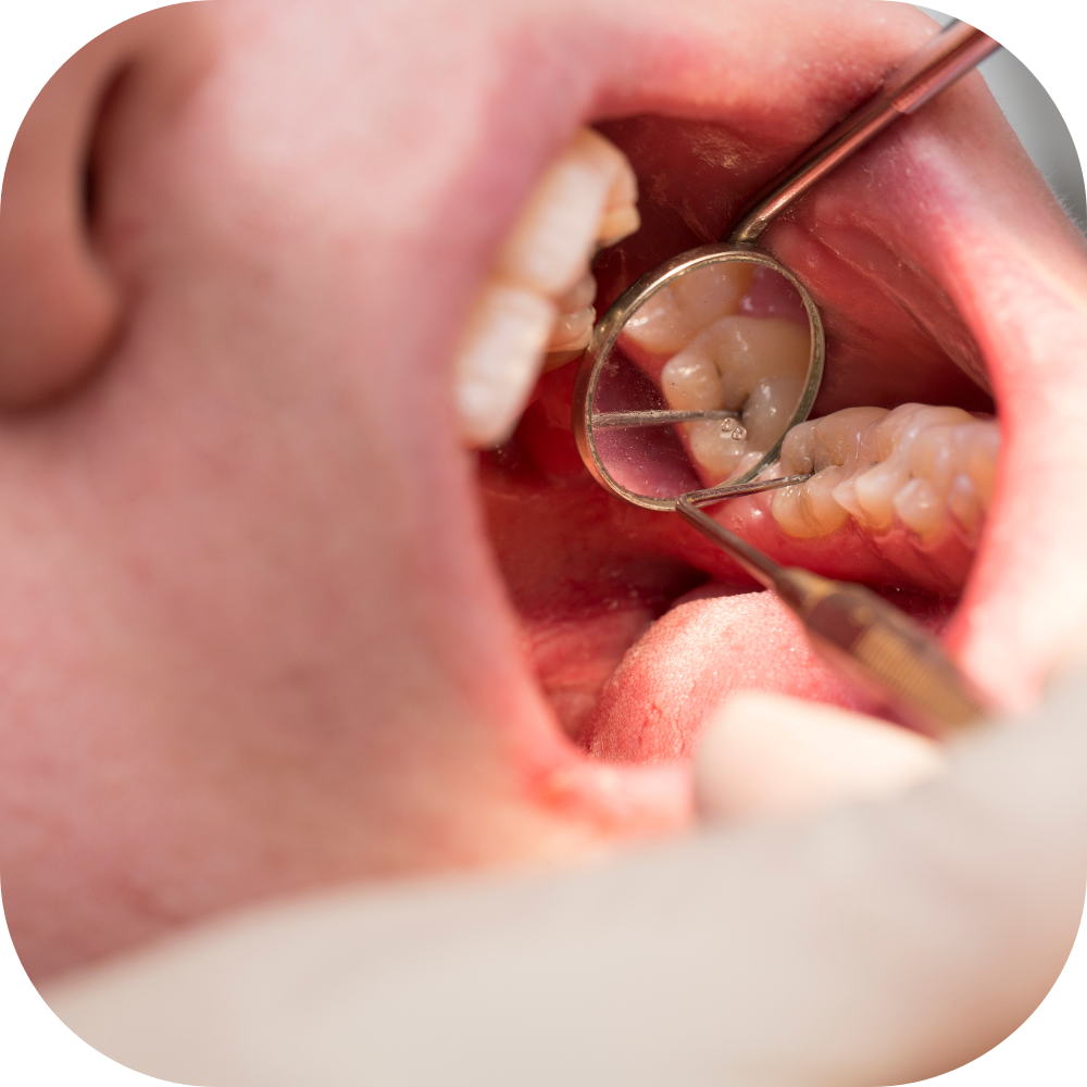 Nguyên nhân gây ra tình trạng chân răng bị đen