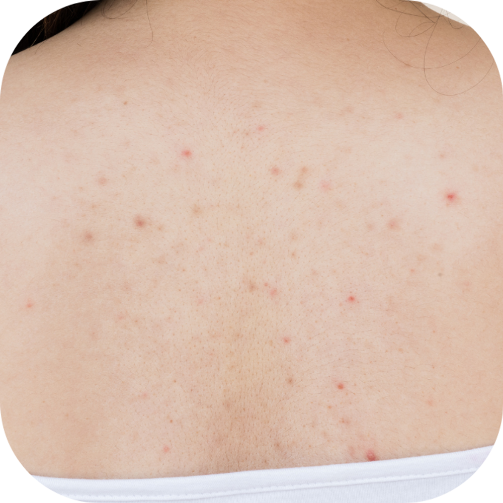 Mụn lưng Kingfoodmart