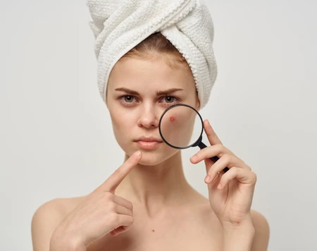 Nguyên nhân và cách xử lý mụn trứng cá