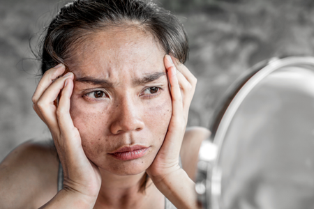 Tìm ra nguyên nhân khiến bạn nám da